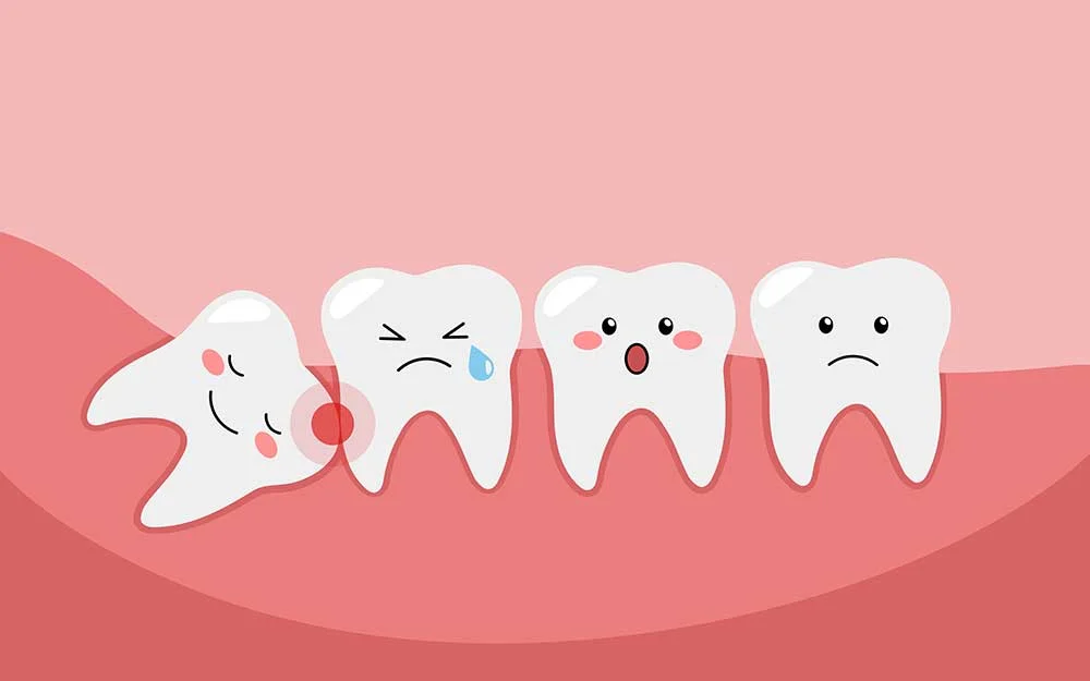 Wisdom Teeth And Pericoronitis Cyst Formation around the wisdom tooth but this is uncommon at ghauri dental centres