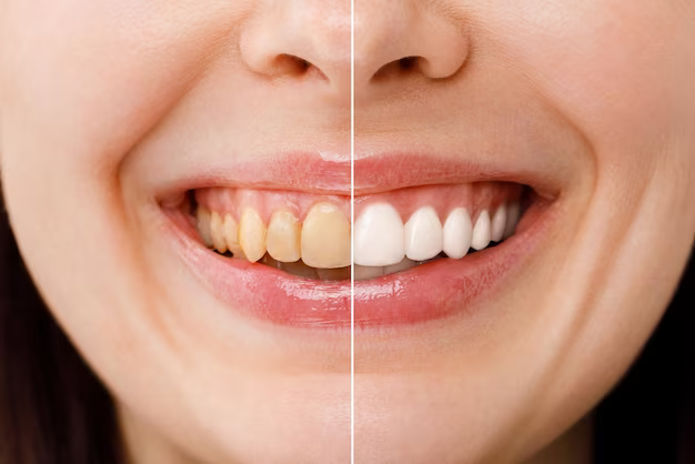 The Benefits of Teeth Whitening