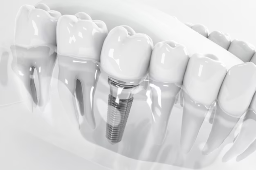 The Wonders of Dental Implants